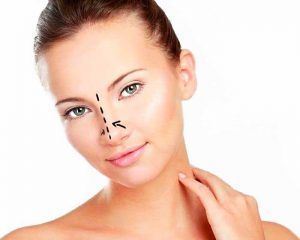 Rhinoplasty nose surgery