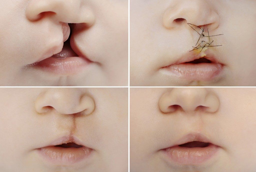 reconstruction des lèvres