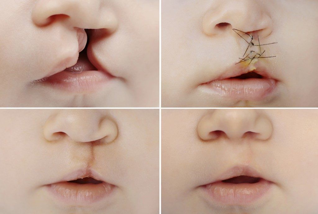 reconstrucción de labios