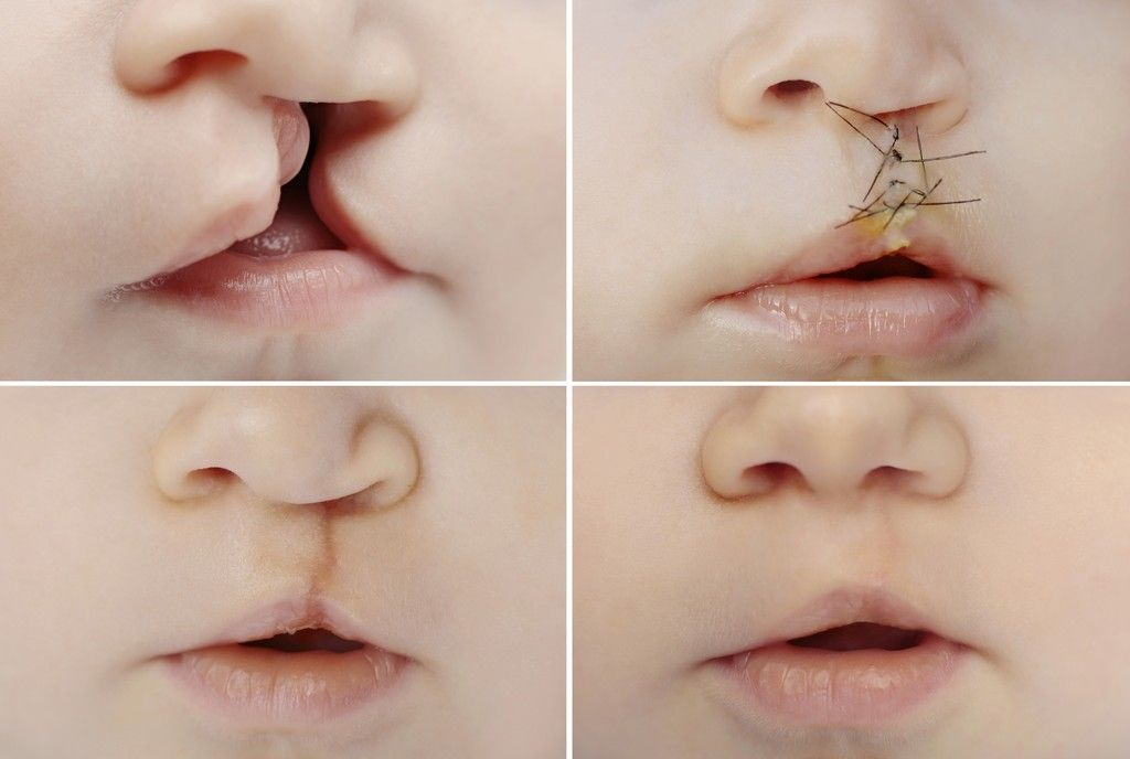 Lips reconstruction surgery