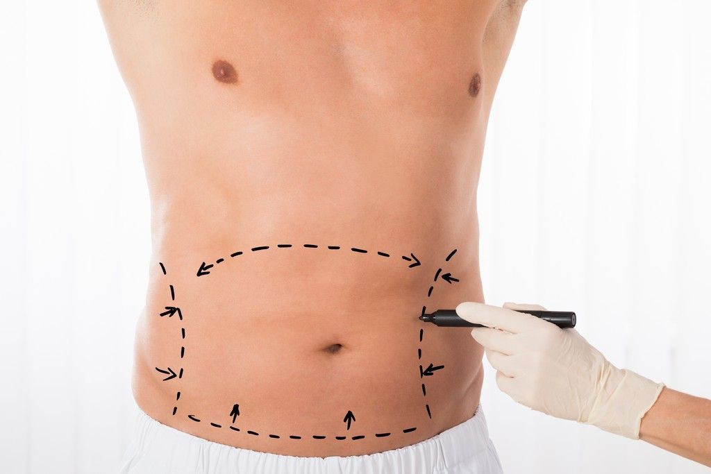 Liposucción de abdomen y espalda de alta definición (HD)