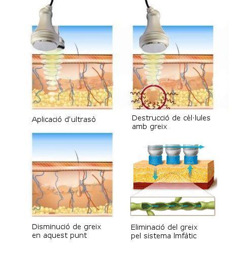 Esquema de cavitació