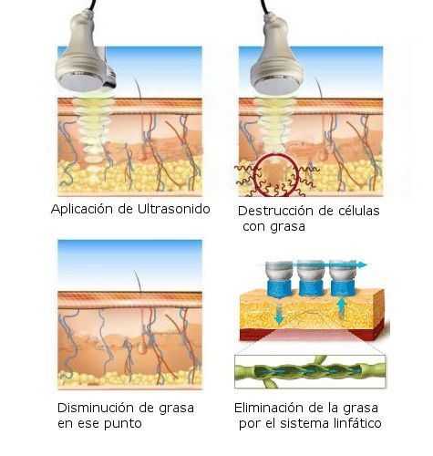 Cavitación, radiofrecuencia y vacumterapia o drenaje linfático