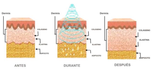 Cavitacion Radiofrecuencia y Vacumterapia en Barcelona