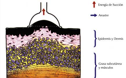 Cavitación, radiofrecuencia y vacumterapia y drenaje linfático