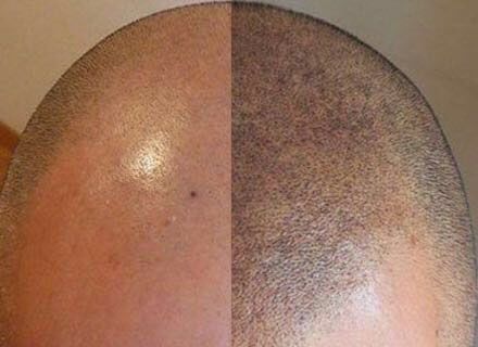 Micropigmentació capil·lar: abans i després