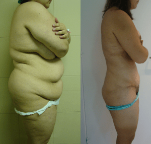 super liposucción - megaliposucción - caso 1