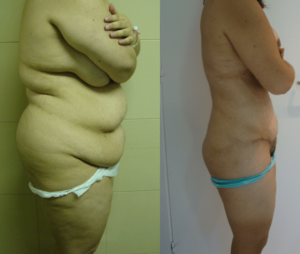 super liposucción - megaliposucción - caso 1
