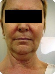 Cirurgia de coll gruixut i flàccid 6.1