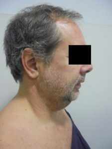 Cirurgia de coll gruixut 5.1