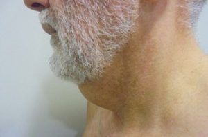 Cirurgia de coll gruixut i flàccid  4.3