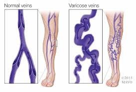 eliminar varices