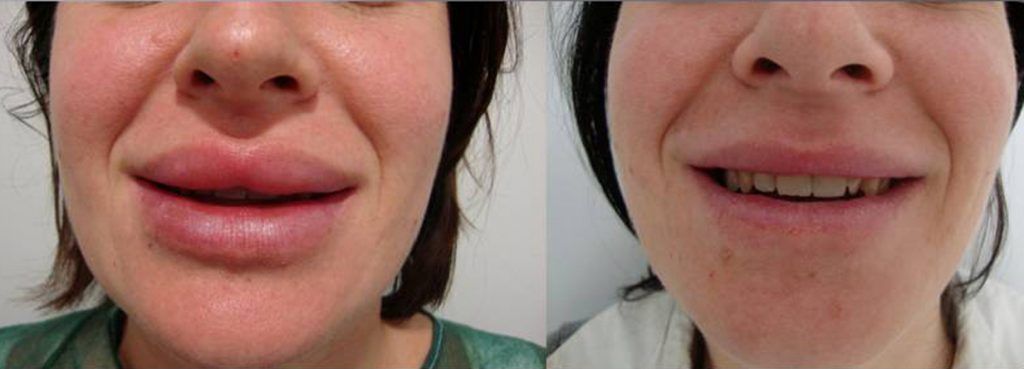 Extracción de biopolímeros de los labios Extracción de biopolímeros de los labios
