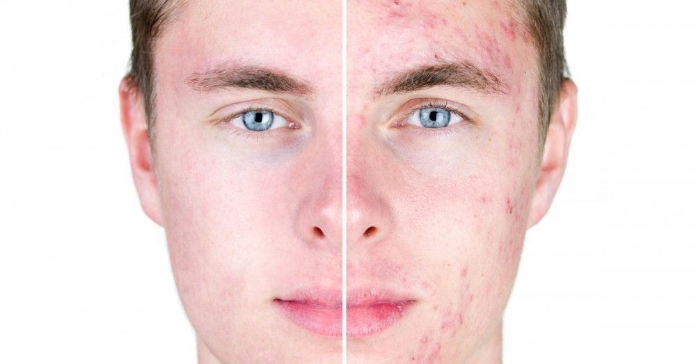 Tractament contra l'acné