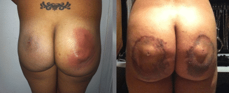 Experts in removing biopolymers and silicone from the body in Barcelona.