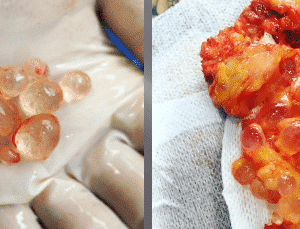 extracción de silicona o biopolímeros del cuerpo - foto 3