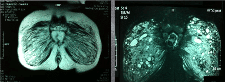 extracción de silicona o biopolímeros del cuerpo - foto 4