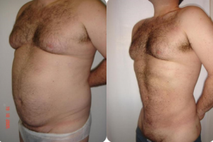 Imatge lipoescultura amb lipoaspiració 2