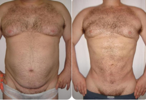 Imatge lipoescultura amb lipoaspiració 1