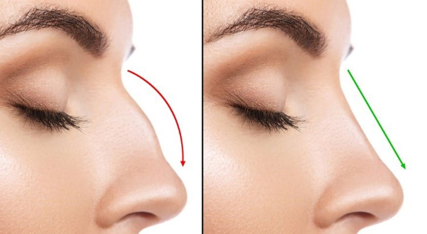 Difference between a rhinoplasty and a septoplasty - photo 1