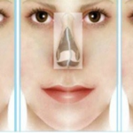 Difference between rhinoplasty and septoplasty