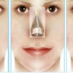 Diferencia-entre-rinoplastia-y-septoplastia-foto-2