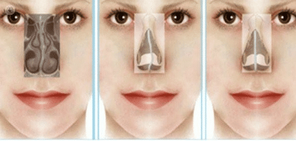 Difference-between-rhinoplasty-and-septoplasty-photo-2