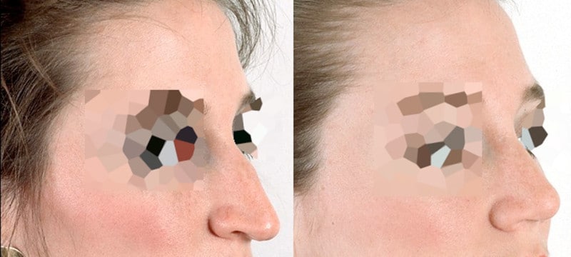 Diferencia entre rinoplastia y septoplastia - foto 3