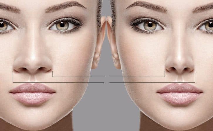 Diferencia entre rinoplastia y septoplastia - foto 4