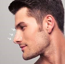 Difference between rhinoplasty and septoplasty- photo 5
