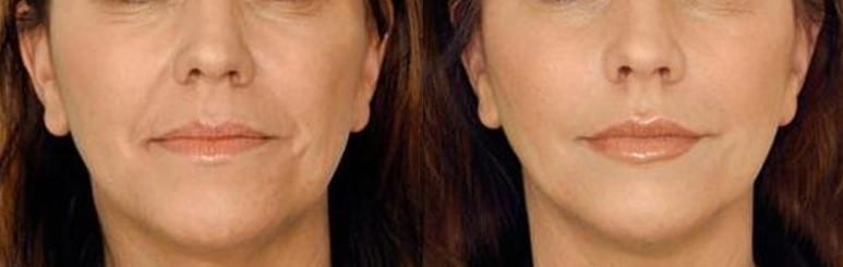 DIFERENCIAS ENTRE ÁCIDO HIALURÓNICO Y BOTOX - foto 4