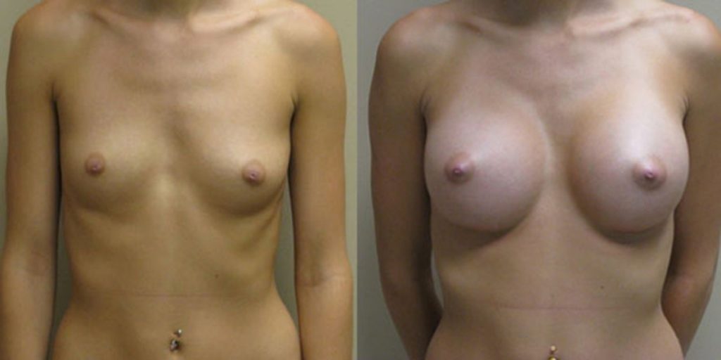 Augment de pit amb pròtesis rodones