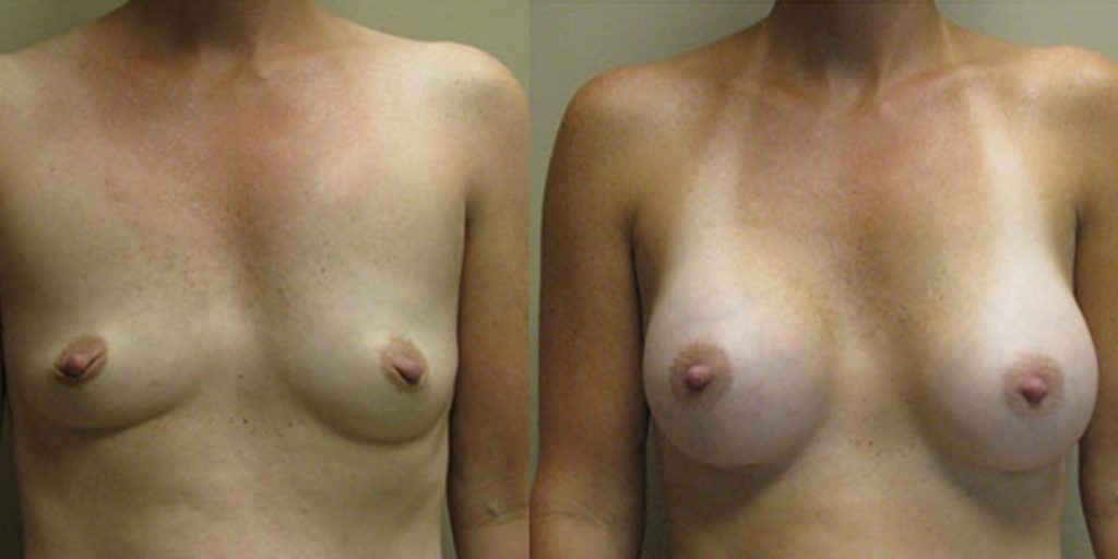 Augment de pit amb pròtesis anatòmiques