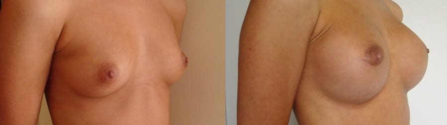 Pròtesis de pit rodones