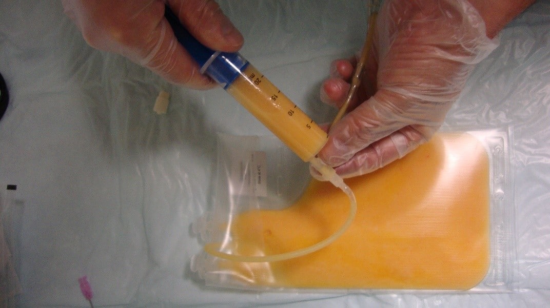 1 - Fat being prepared for lipofilling