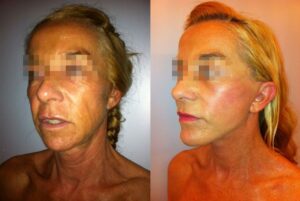 10 - Lipofilling facial