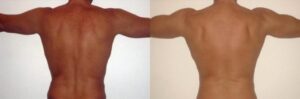 12 - Lipofilling sur les épaules et les biceps