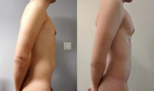 Lipofilling des pectoraux avec de la graisse de l'abdomen 13 - Lipofilling des pectoraux avec de la graisse de l'abdomen