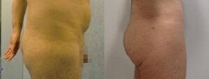 Lipofilling des fesses avec de la graisse de l'abdomen 14 - Lipofilling des fesses avec de la graisse de l'abdomen