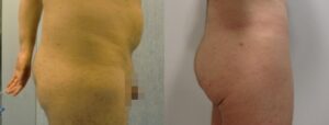 14 - Lipofilling in buttocks with fat from the abdomen
