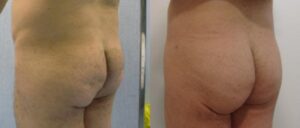 15 - Lipofilling in buttocks with fat from the abdomen