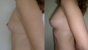 17 - Lipofilling in breasts with fat from the abdomen and thighs