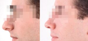 6 – Upper lip advanced correceted with hyaluronic acid
