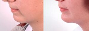 7 - Projection du menton et de la lèvre supérieure avec de l'acide hyaluronique
