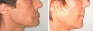 8 - Facial lipofilling