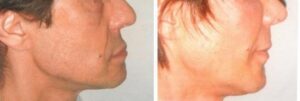 Lipofilling du visage 8 - Lipofilling du visage