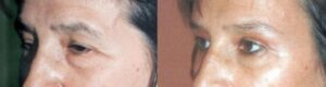 Lipofilling des cernes, des sourcils et de la région temporale 9 - Lipofilling des cernes, des sourcils et de la région temporale