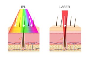 Différences entre le laser et la lumière pulsée (IPL)