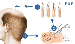 Transplante de pelo - foto 4