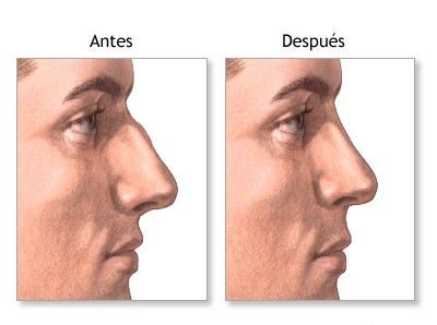 Rhinoplasty-photo3